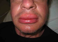 Dudak Şişmesi Belirtileri ve Tedavisi