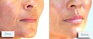 Dudak Dolgunlaştırıcı Yağ Kullanımı ve Faydaları Nelerdir?